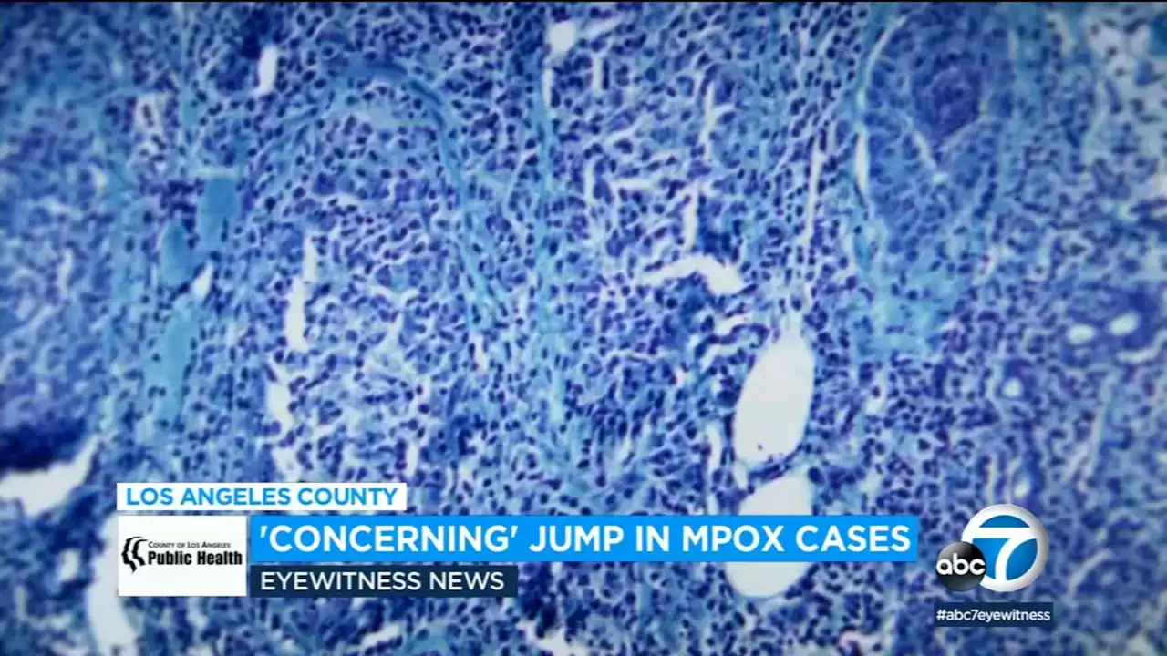 LA County health officials report 'concerning' spike in mpox cases