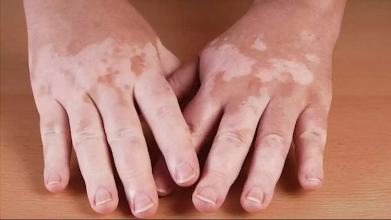 Hari Vitiligo Sedunia 25 Juni, Kenali Apa Penyakit Itu, Penyebab dan Cara Menanganinya