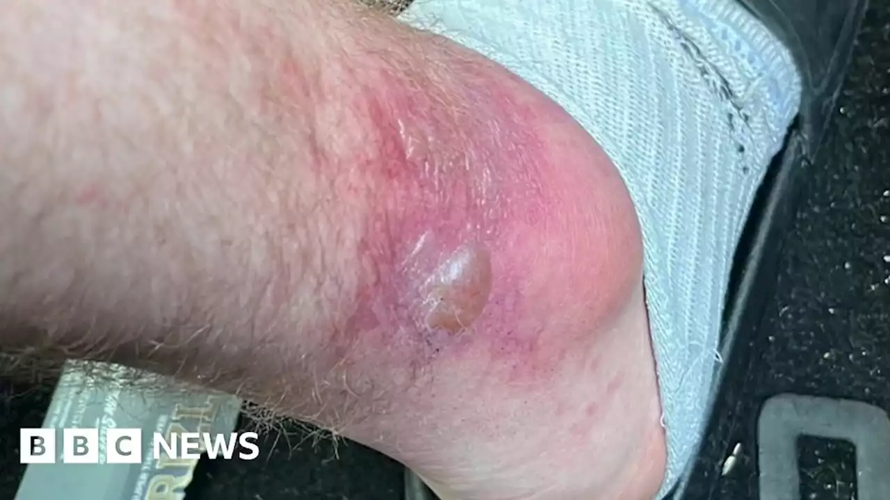 Giant hogweed warning after London man left with scarring