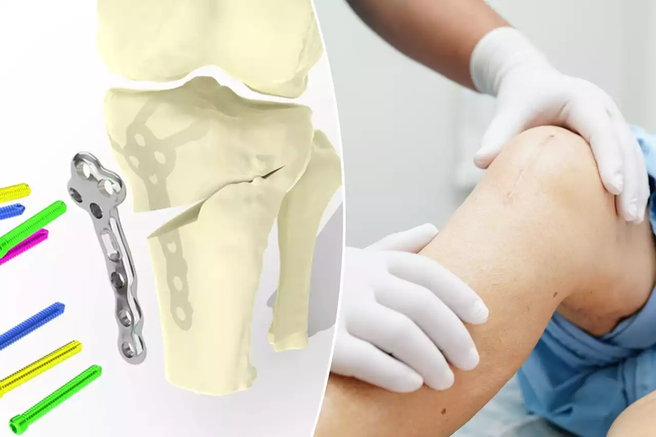 Revolutionary 3D printed artificial knee is tailored to the patient