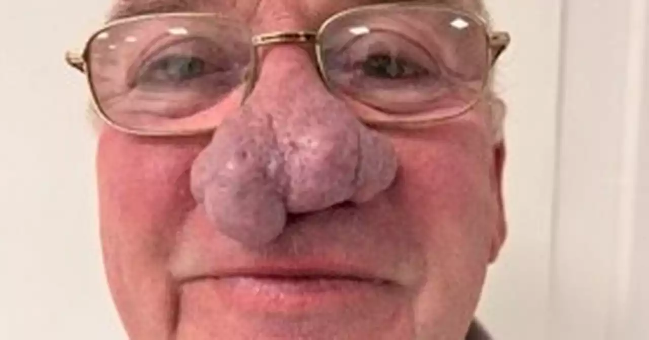 Scots grandad forced to pay to have huge nose growth removed and slams NHS