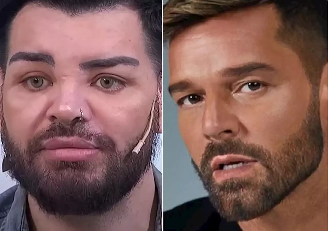 Ator faz 30 cirurgias plásticas para se parecer com Ricky Martin e lamenta erros médicos: ‘Não consigo enxergar’