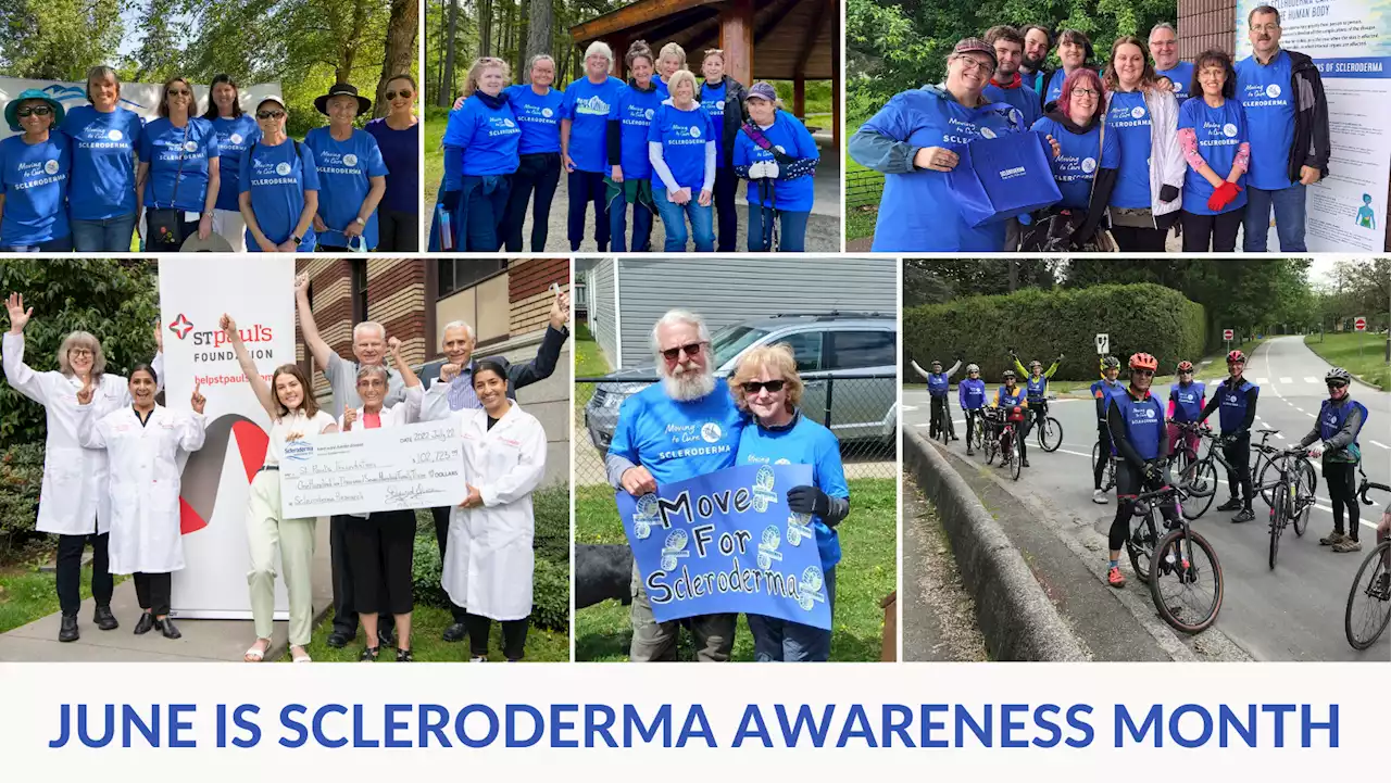 World Scleroderma Day: Another rare disease that takes years to diagnose