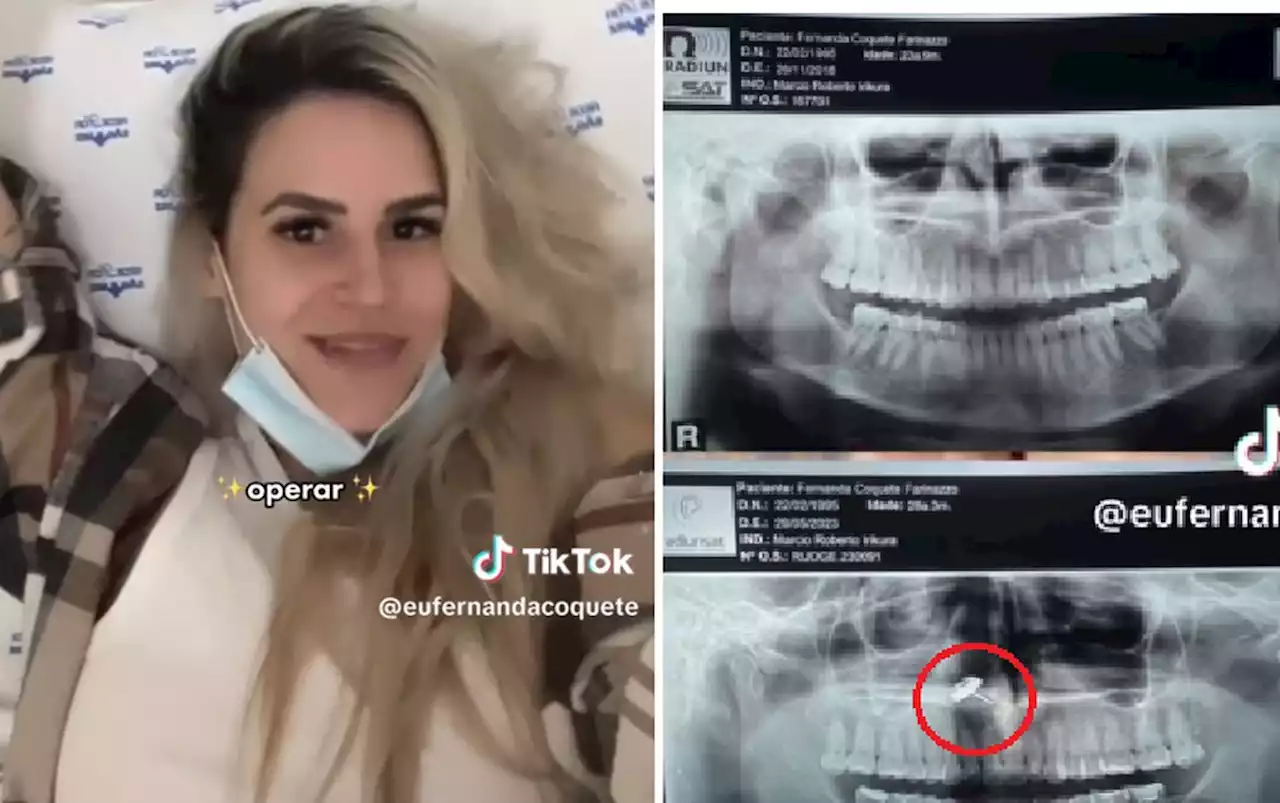 Vídeo: Jovem descobre brinco perdido dentro de nariz e passa por cirurgia de emergência; entenda