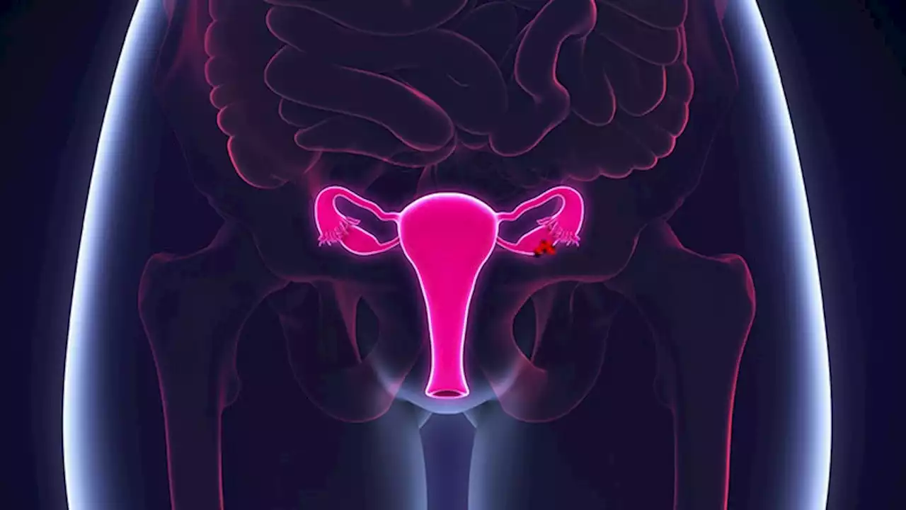 'Huge Step Forward' in Advanced Ovarian Cancer