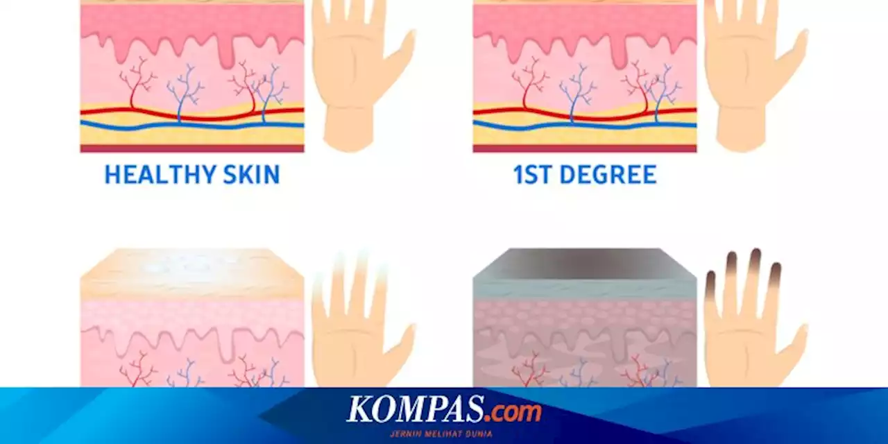 Kenali Apa Itu Frostbite, Penyebab, dan Tanda-tandanya