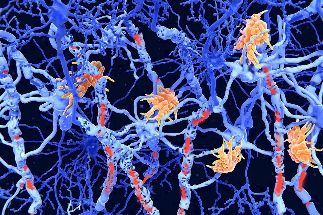 Genetic marker discovered for the severity of multiple sclerosis