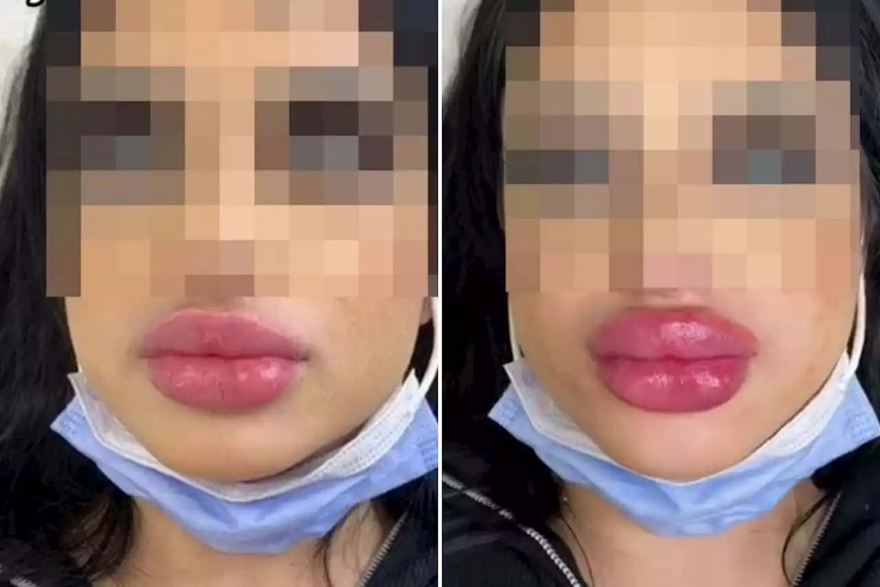 Beautician torn to shreds over filler client who wanted 'even bigger lips'