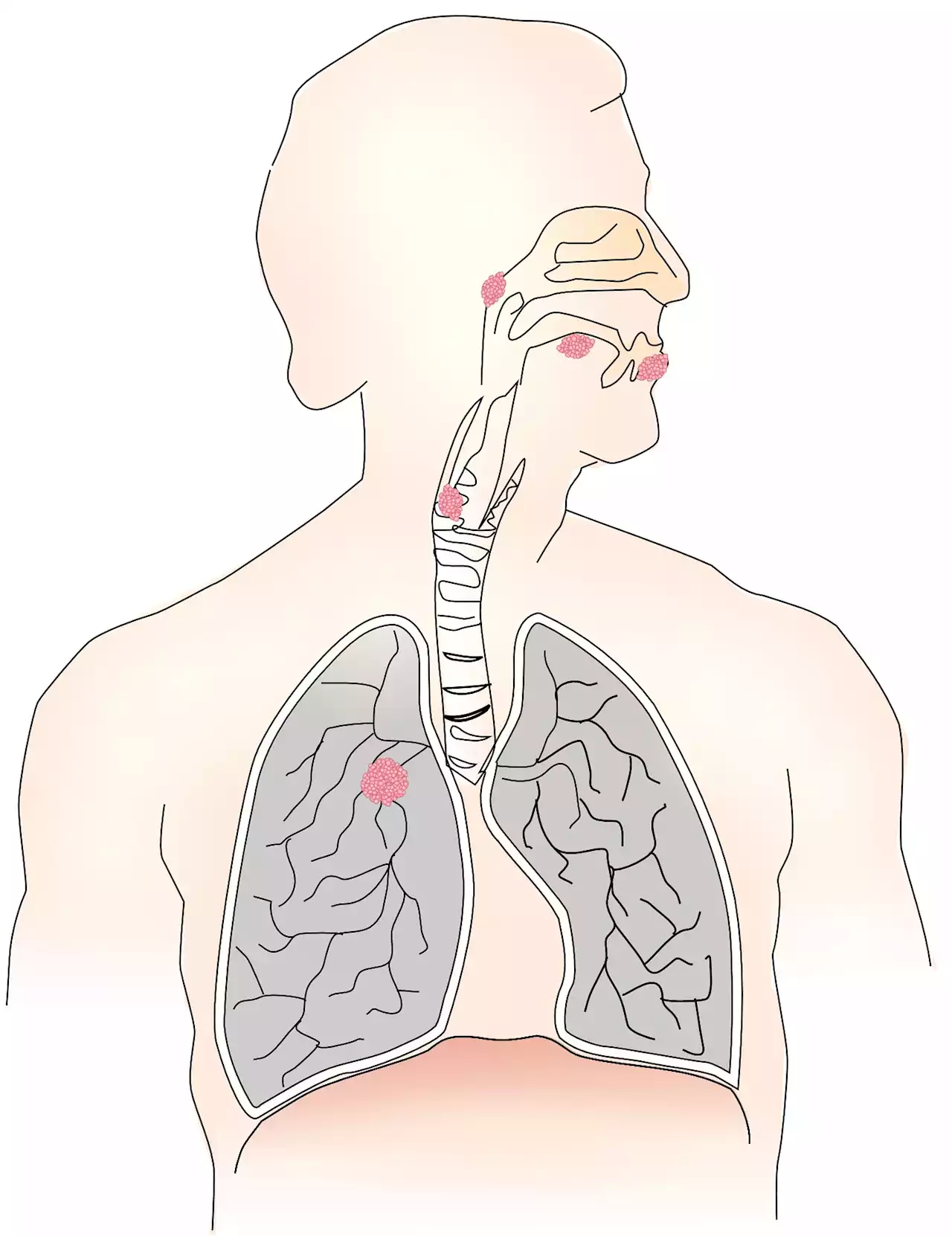 Real-world data suggests stopping immunotherapy after two years is reasonable in patients with advanced lung cancer