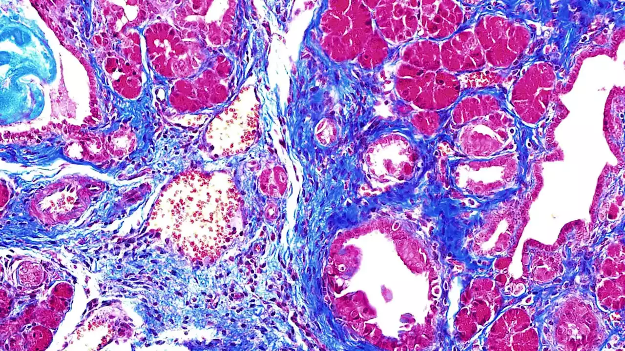 Beware the Splice of Life: This Killer Protein Causes Pancreatic Cancer