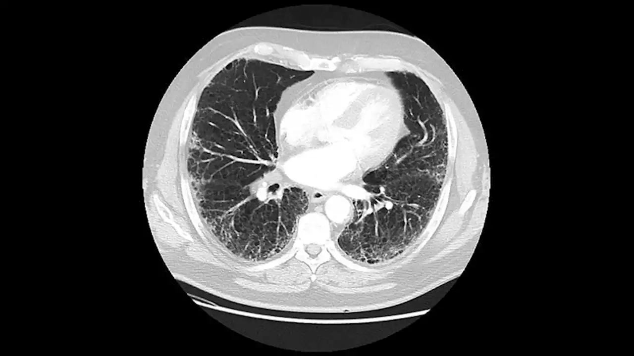 ILD Risk Elevated in RA, PsA After Starting DMARDs