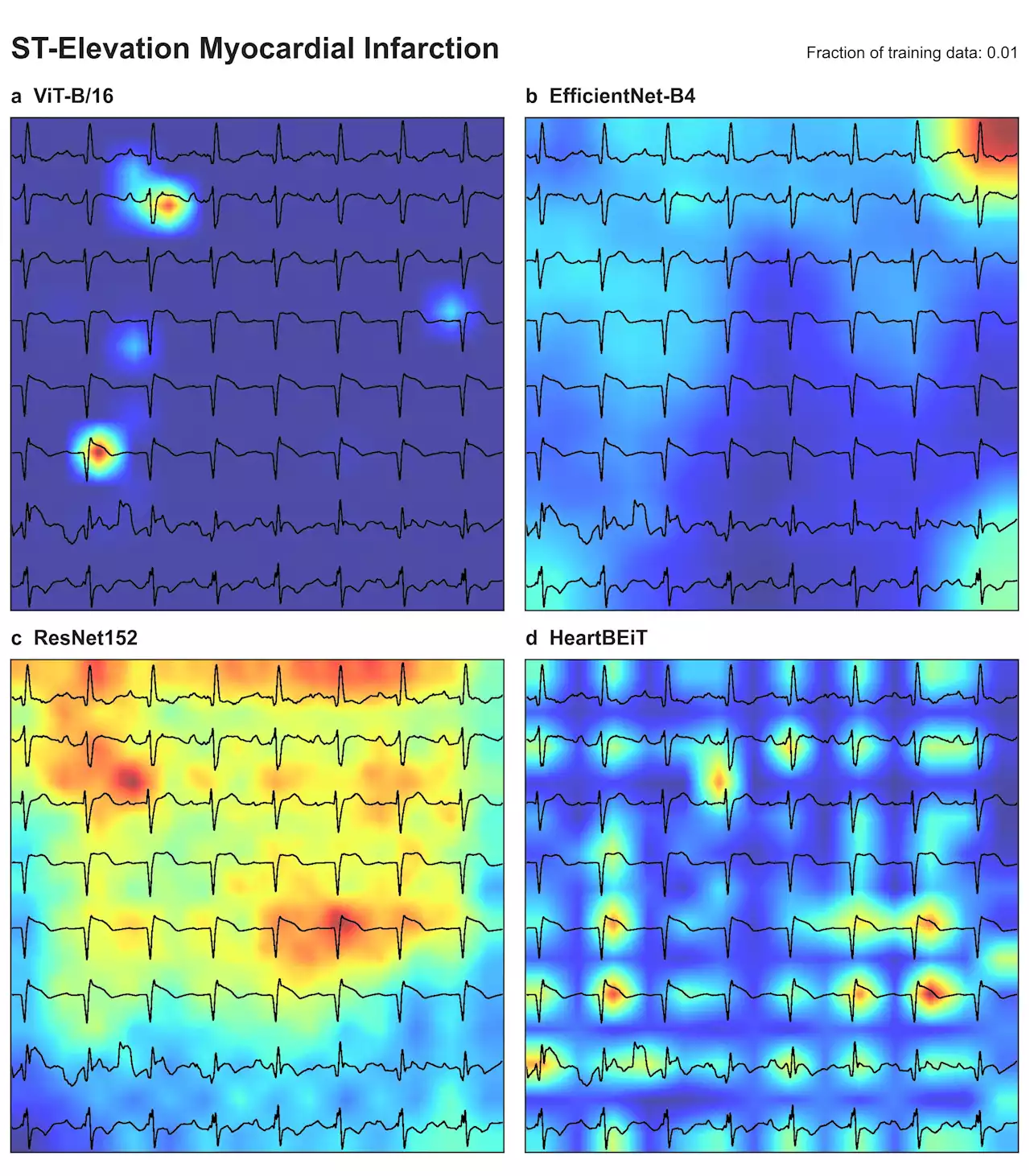 Researchers use new deep learning approach to enable analysis of electrocardiograms as language