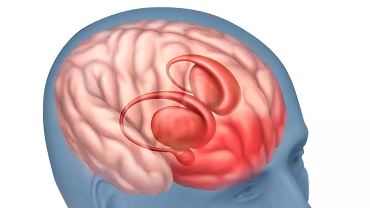 Fast Five Quiz: Schizophrenia Management in Adults