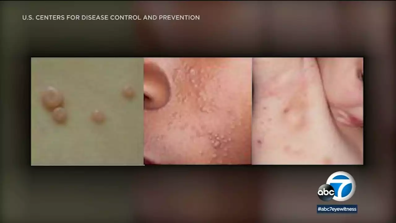 FDA warns against self-diagnosis, bogus treatments for this common skin condition