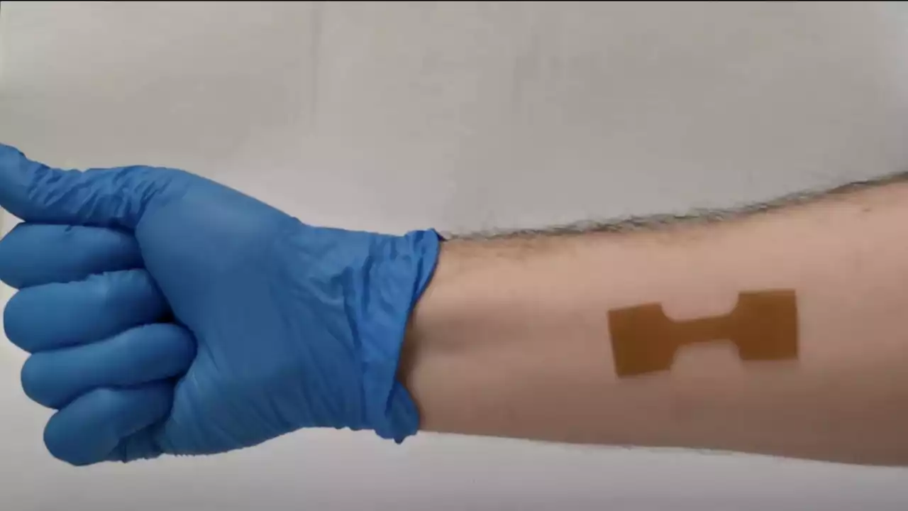 Novel 3D-printed wound dressing could enhance healing of burn patients