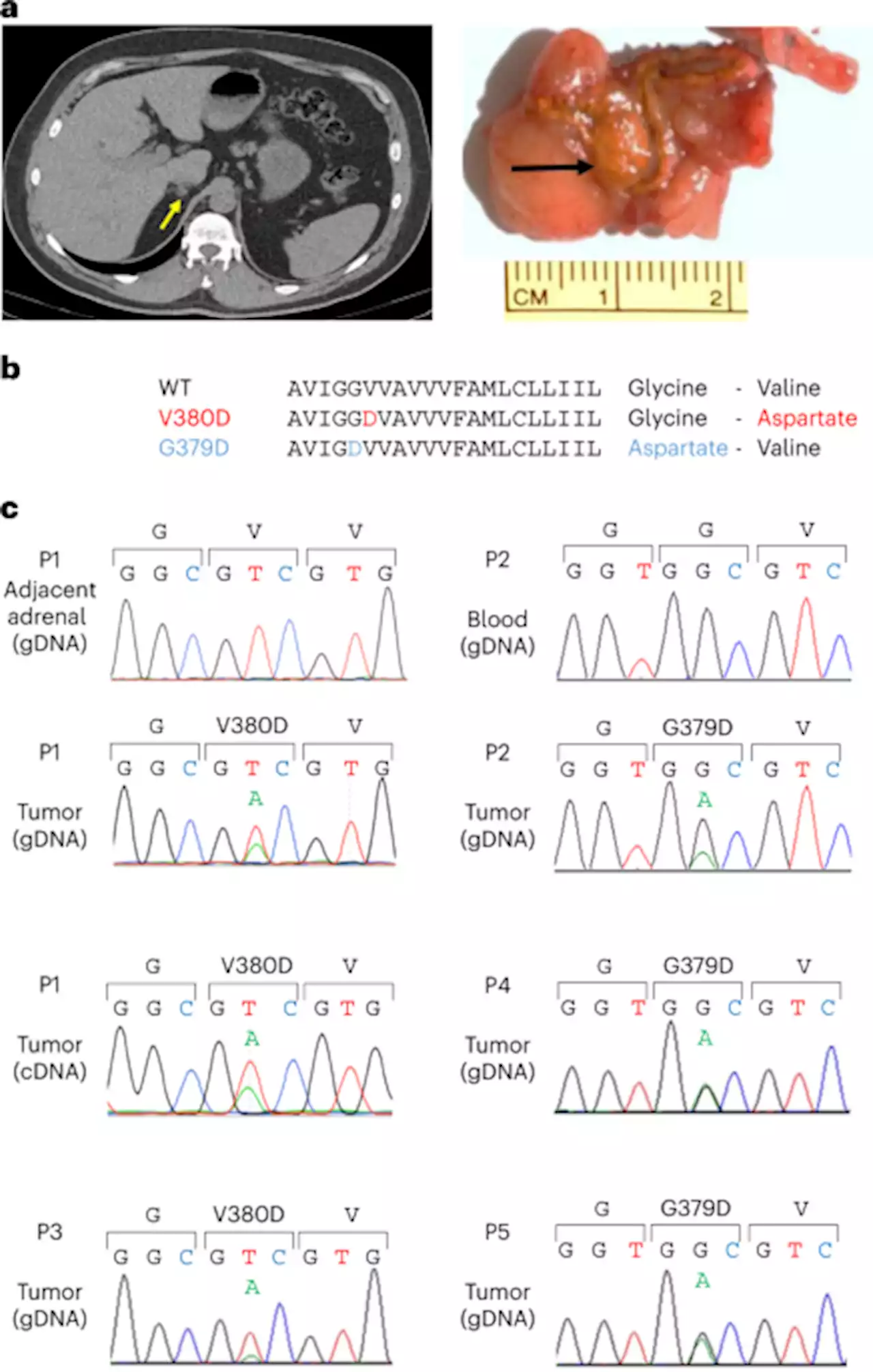 Somatic mutations of CADM1 in aldosterone-producing adenomas and gap junction-dependent regulation of aldosterone production - Nature Genetics