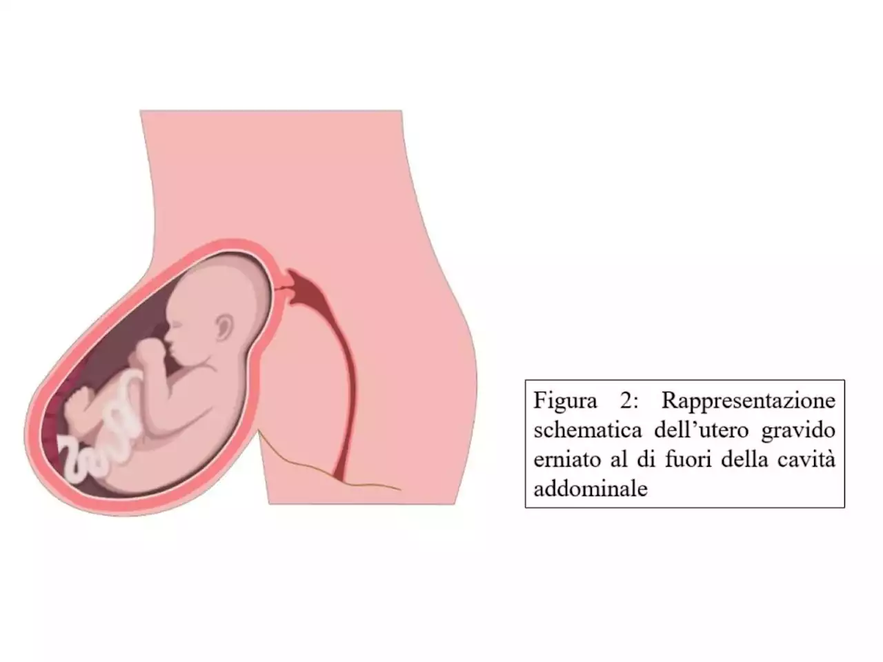 Gravidanza in utero fuori dall'addome, parto riuscito - Salute & Benessere