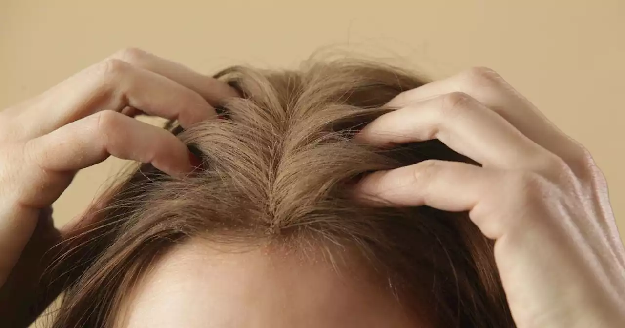 Expert warns 'overreliance' on dry shampoo could cause hair loss