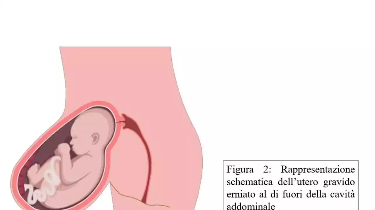 Gravidanza in utero fuori dall'addome, parto riuscito a Torino