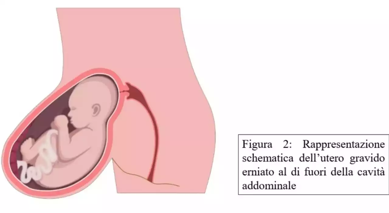 Gravidanza con utero e feto dentro un'ernia fuori dall'addome: l'intervento miracoloso che ha permesso di salvare mamma e neonata