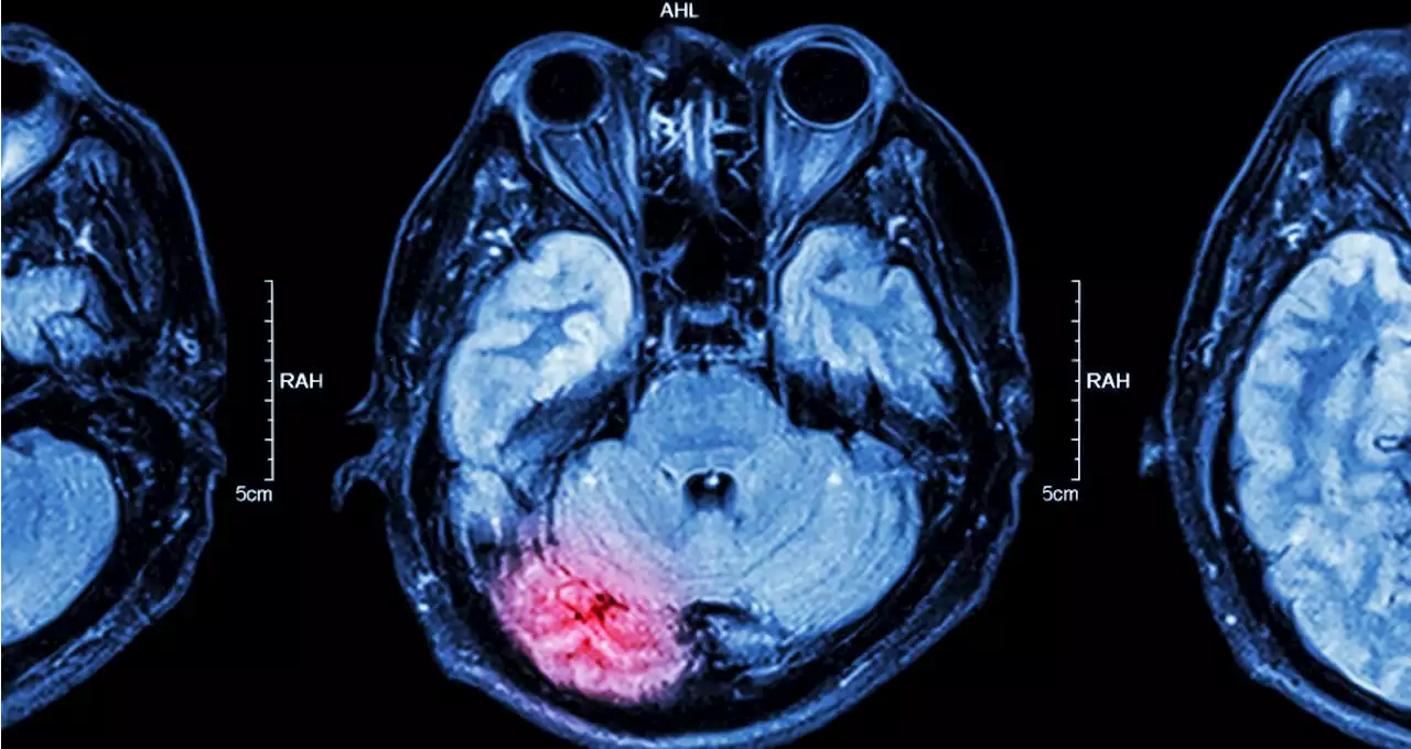 Noninvasive Brain Stimulation Promising for Acute Stroke