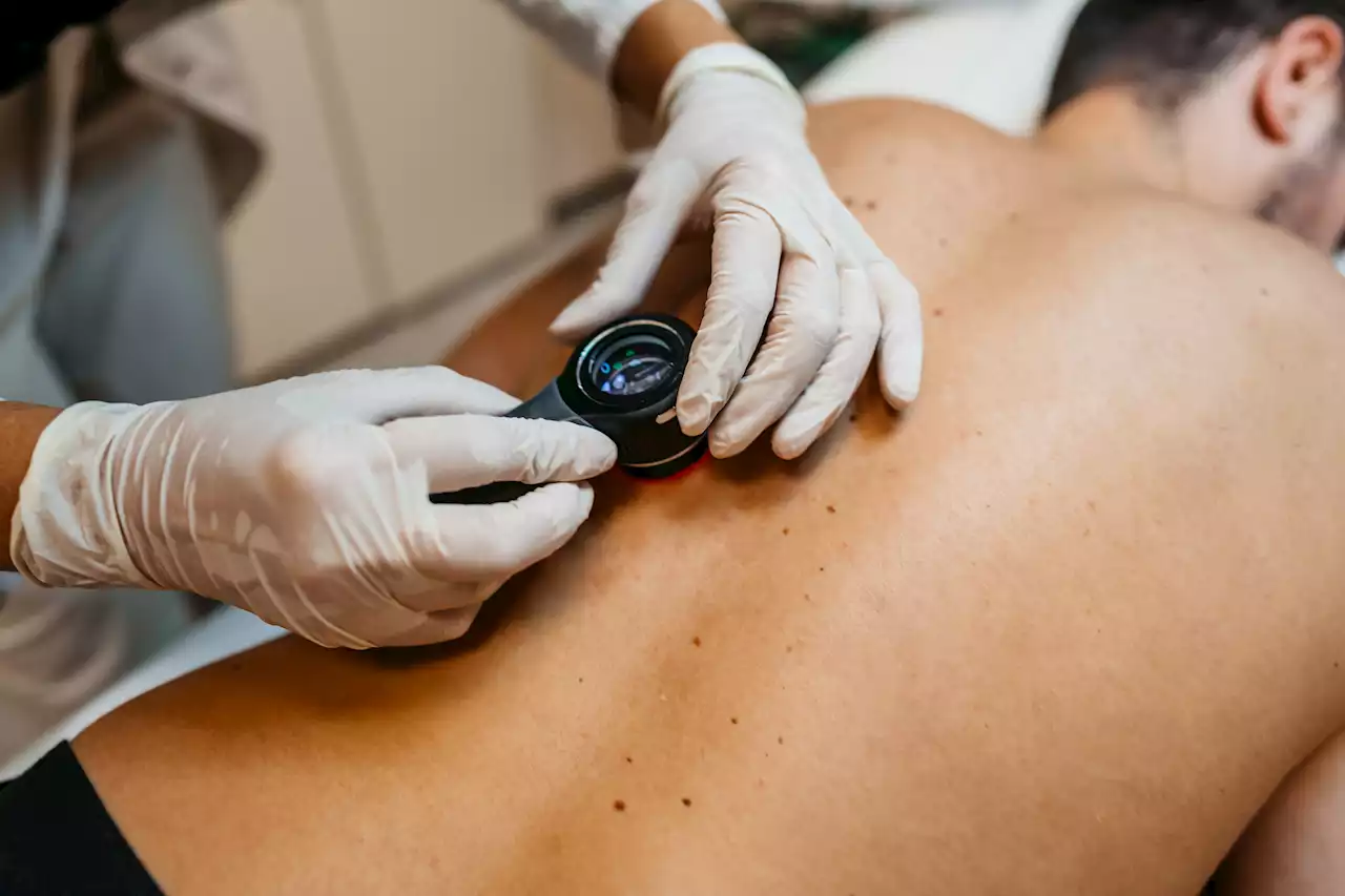 Study: Melanoma Survival Rates Vary Dramatically By Race