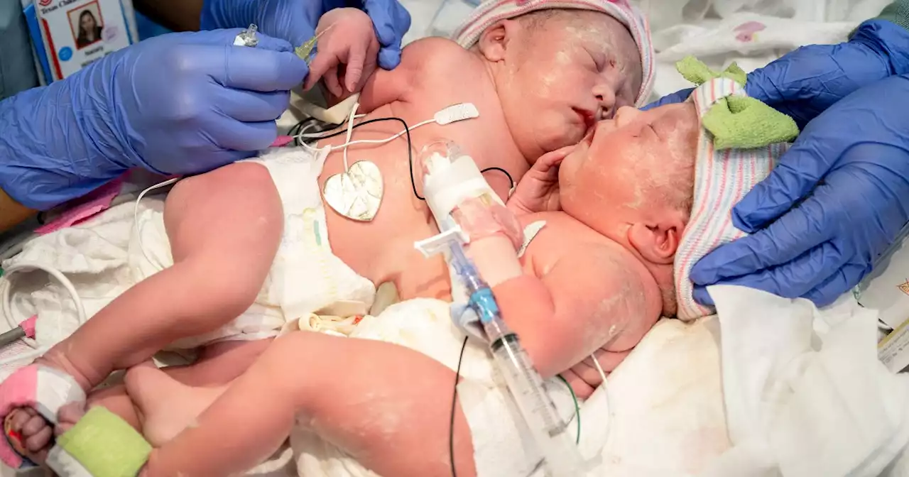 Parents detail journey to save conjoined twins sharing a liver: ‘Blessing and a curse’