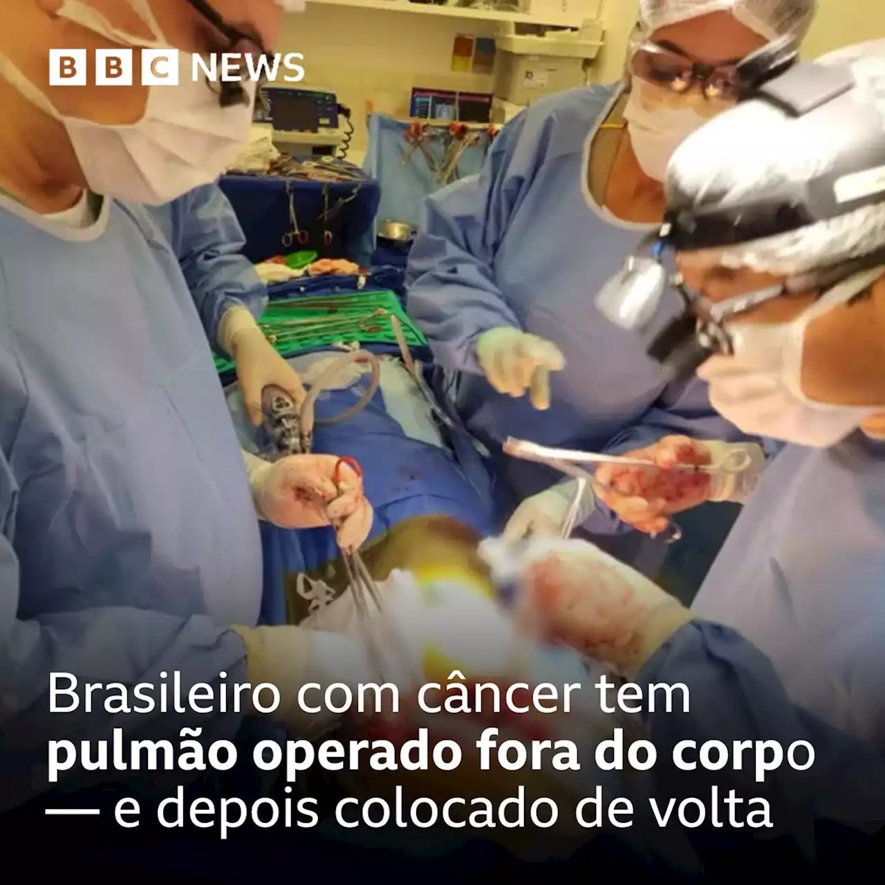 Câncer: brasileiro tem pulmão operado fora do corpo — e depois colocado de volta - BBC News Brasil