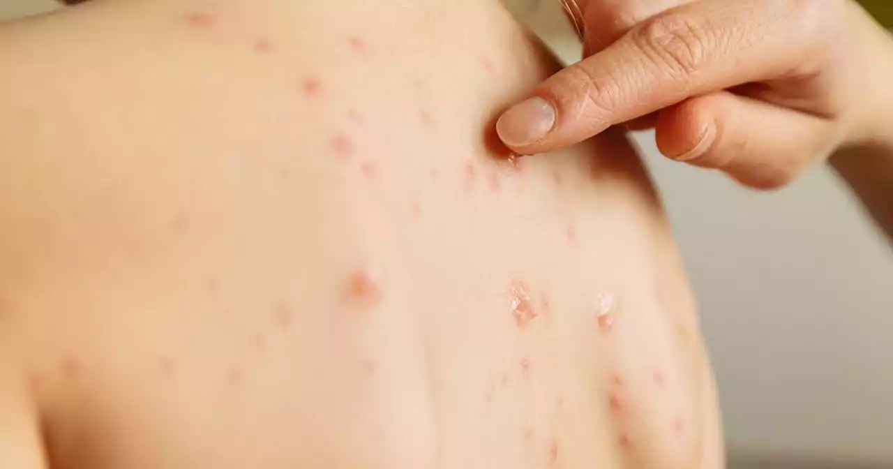 Chickenpox vaccine for all children moves a closer as Hiqa advises addition to State immunisation programme