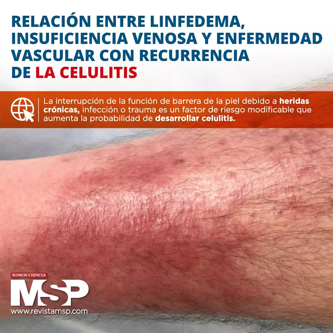 Relación entre linfedema, insuficiencia venosa y enfermedad vascular con recurrencia de la celulitis