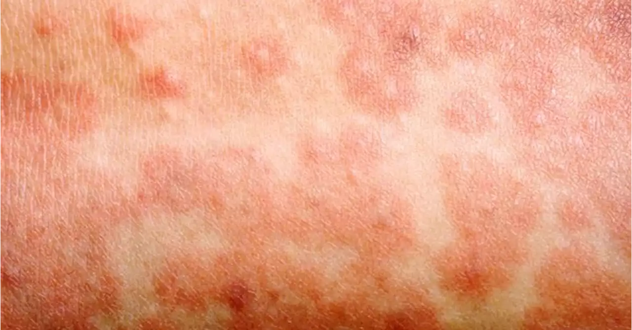 Warning Over UK Measles Outbreak, With Tens Of Thousands Of Predicted Cases