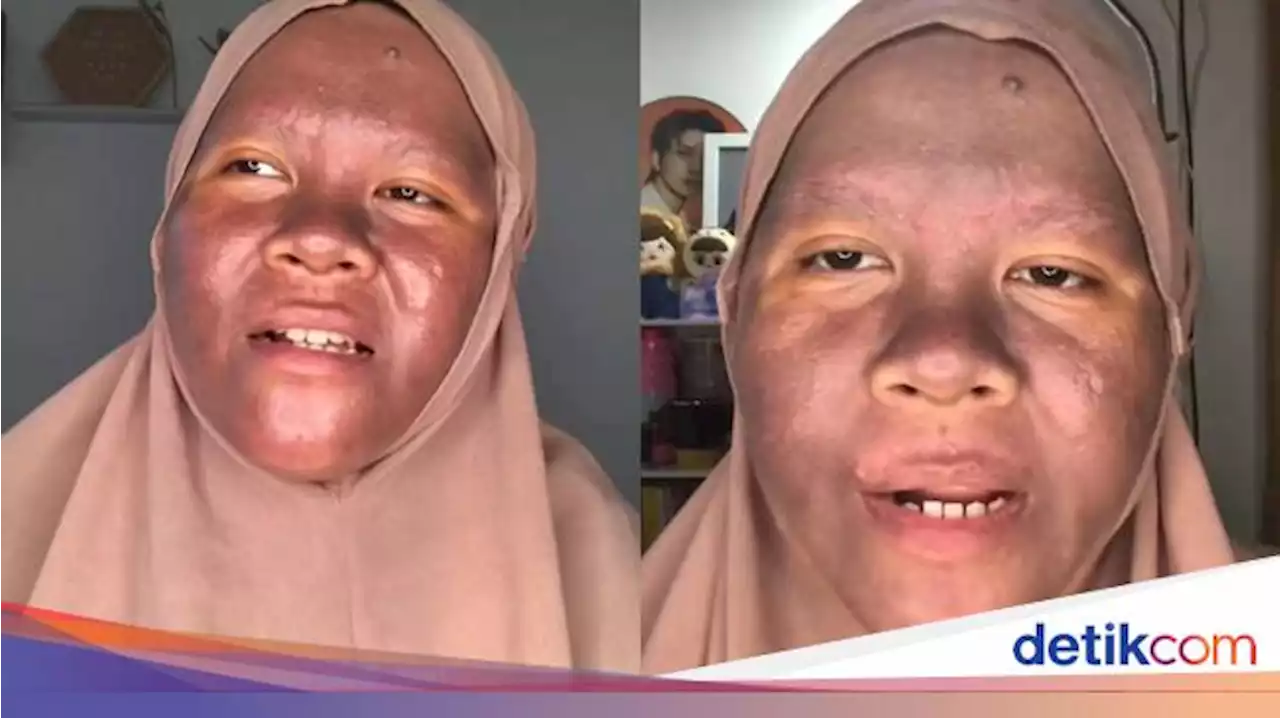 Awal Mula Wanita Kaltim Pakai Krim Pemutih Berujung Wajah Menggosong