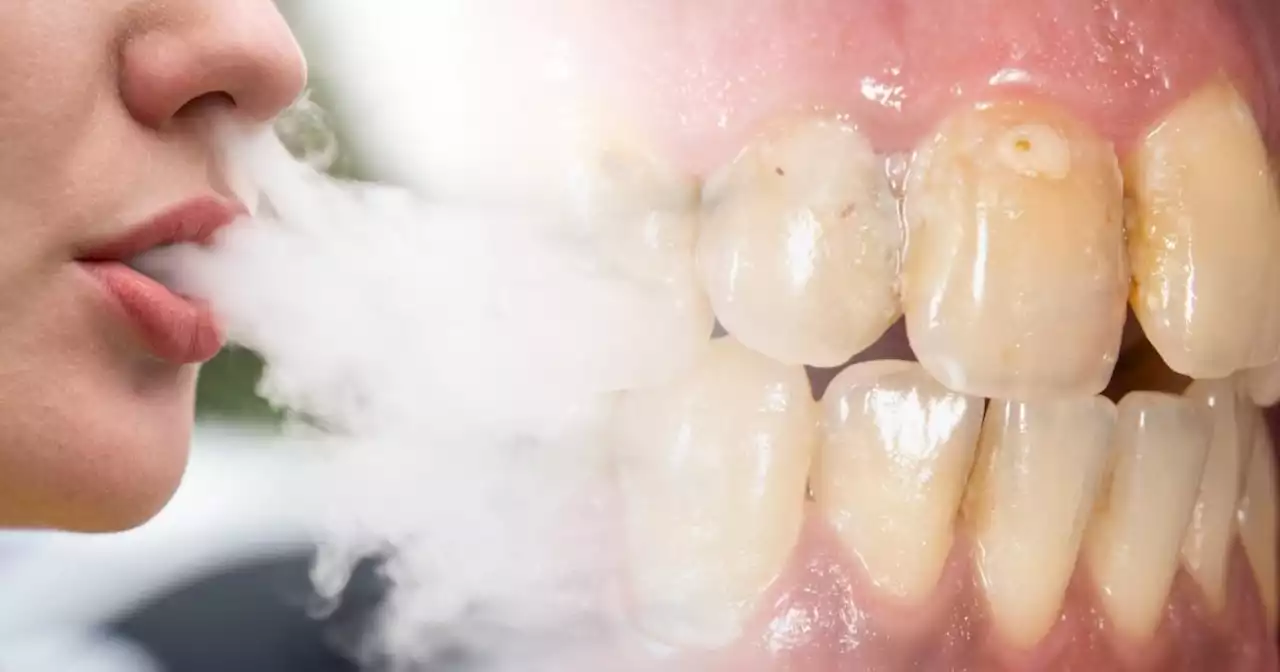 Five ways vaping ruins your teeth – and one is irreversible