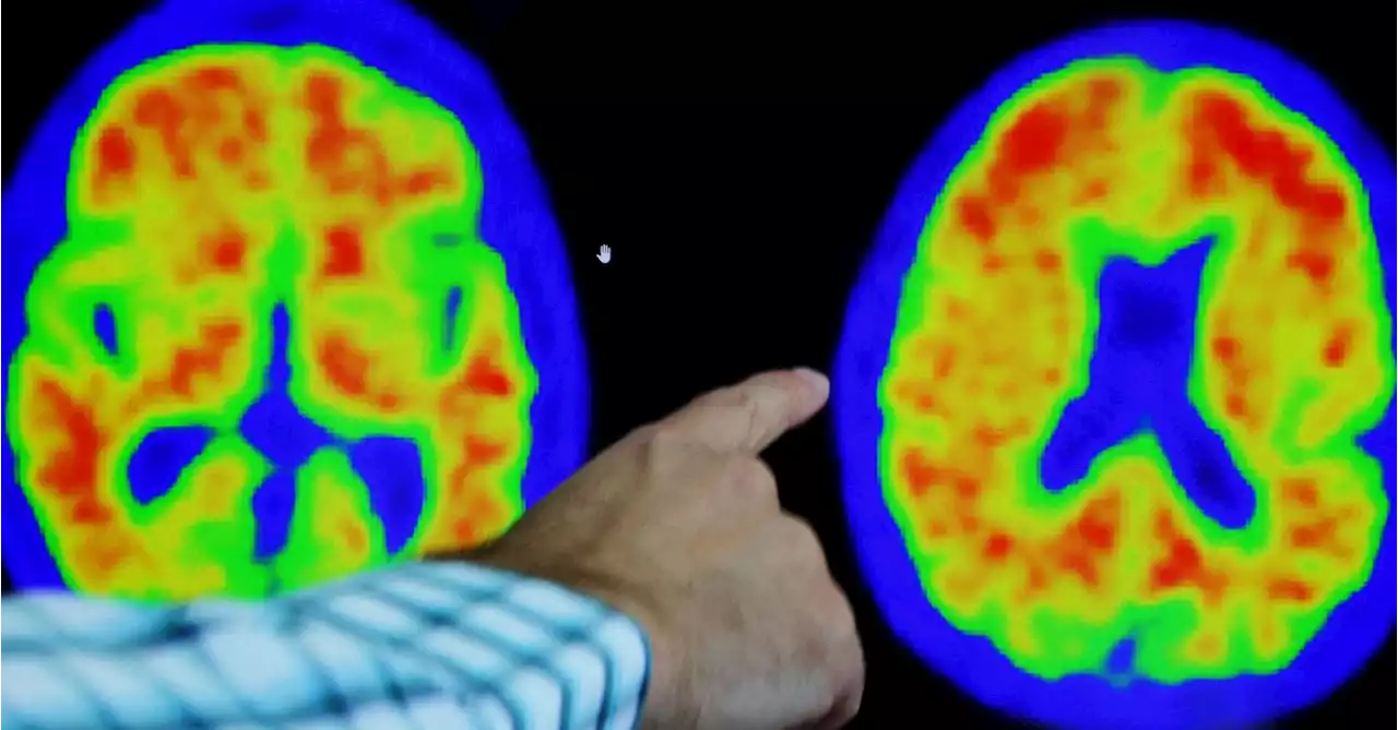 Alzheimer's diagnosis revamp embraces rating scale similar to cancer