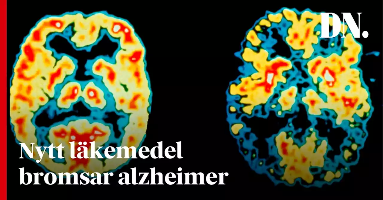 Nytt läkemedel bromsar alzheimer