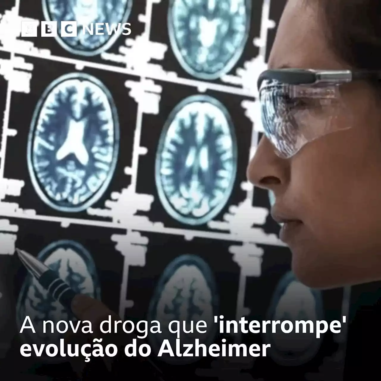 Nova droga 'interrompe' evolução do Alzheimer - BBC News Brasil