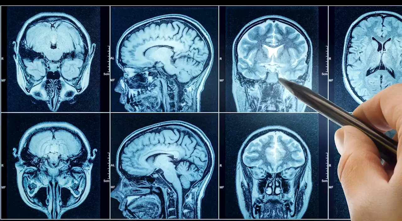 A machine-learning approach for monitoring the progression of Alzheimer's disease