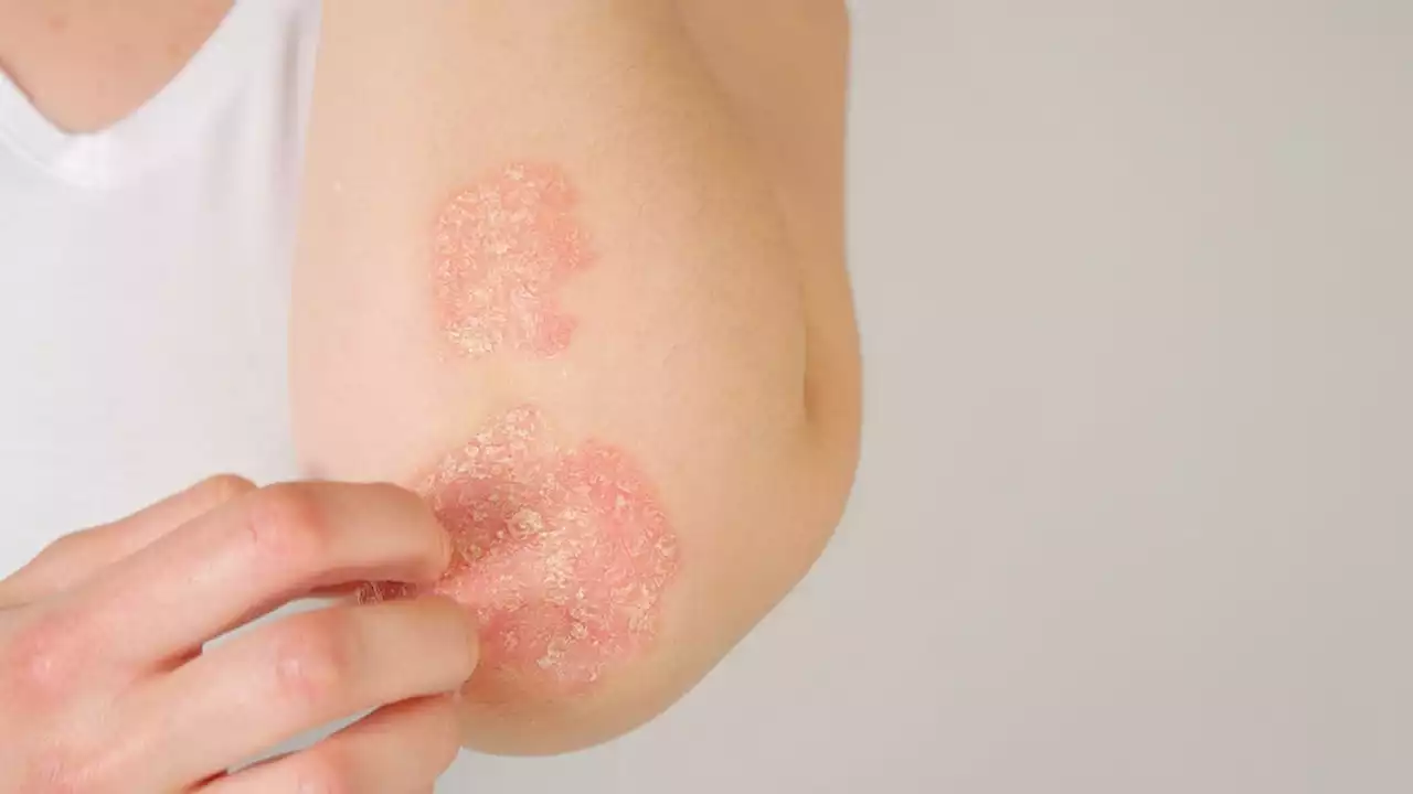 Un nouveau traitement pour le psoriasis autorisé au Royaume-Uni