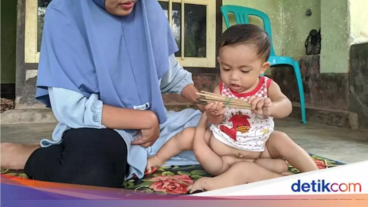 Bayi 'Berkaki 6' Tidak Punya Testis, Parasit di Bawah Perut Segera Dipisahkan