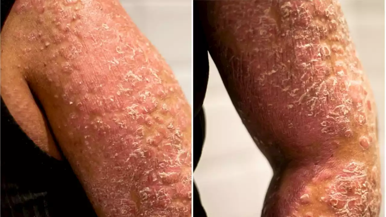 ‘Smells like rotten fish, feels like a curse’: Pain, odour and isolation for people with rare skin disease