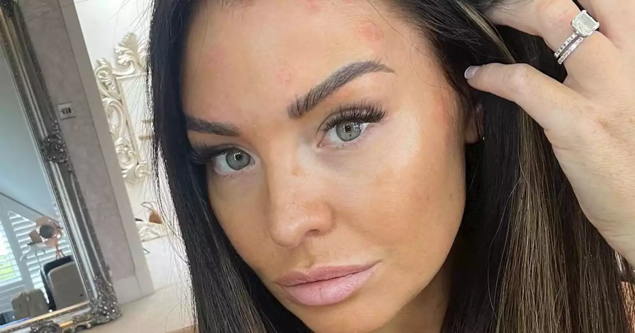 TOWIE's Jess Wright shares update on 'frustrating' psoriasis battle