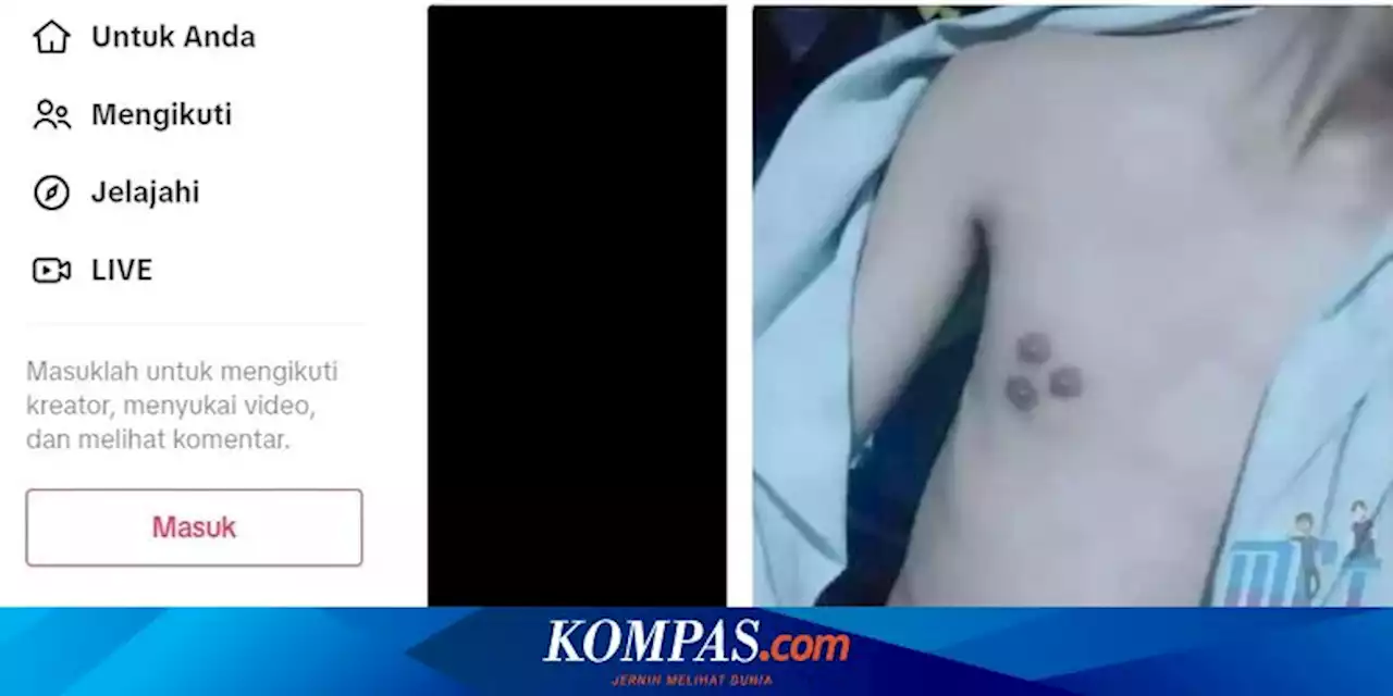 Viral, Foto Laki-laki dengan Tiga Puting, Dokter: Itu Bukan Polymastia