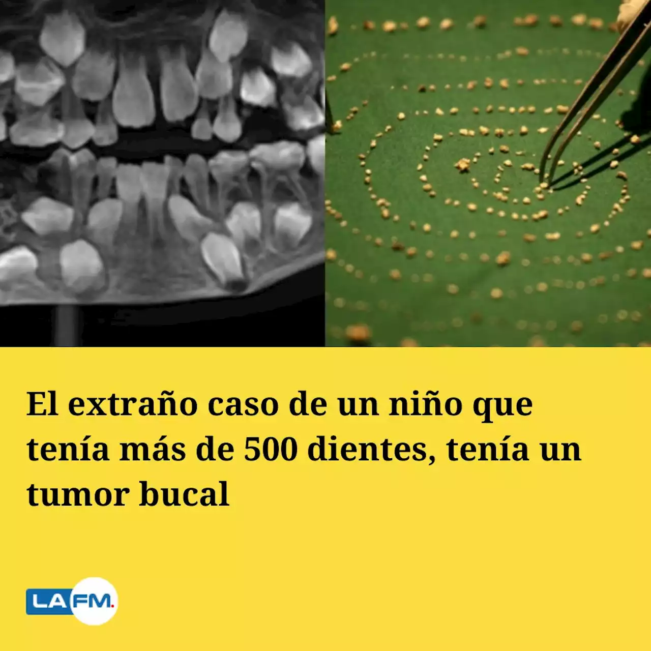 El extraño caso de un niño que tenía más de 500 dientes, tenía un tumor bucal