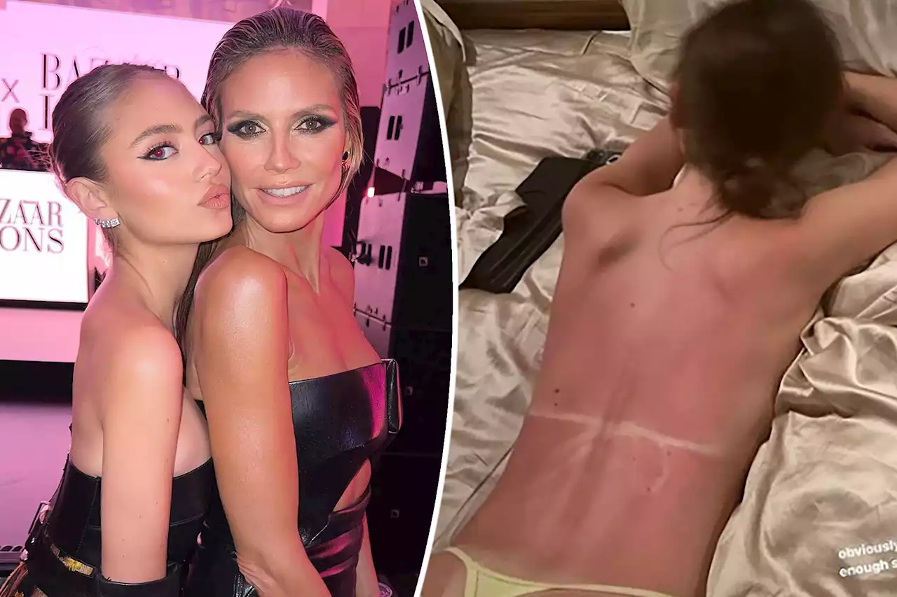 Heidi Klum’s daughter Leni goes topless to show massive sunburn in thong bikini bottoms