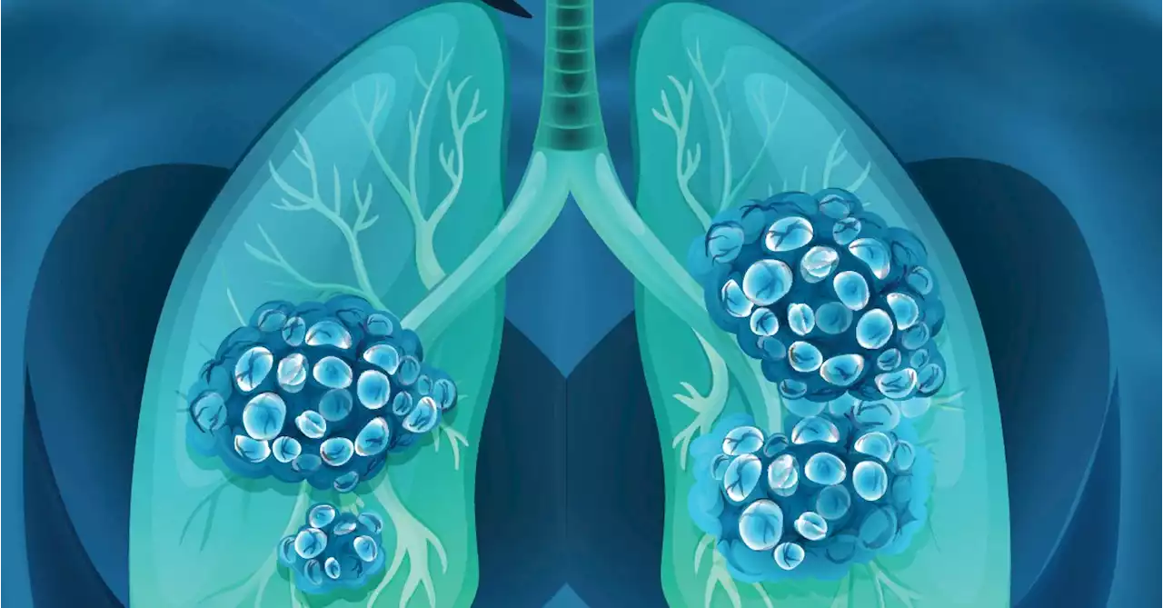 Lung Cancer Stages: Why and How Your Cancer Is Staged