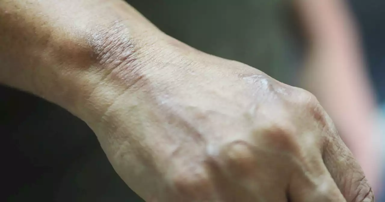 Leprosy could be endemic in Central Florida, CDC says. What to know about the disease.