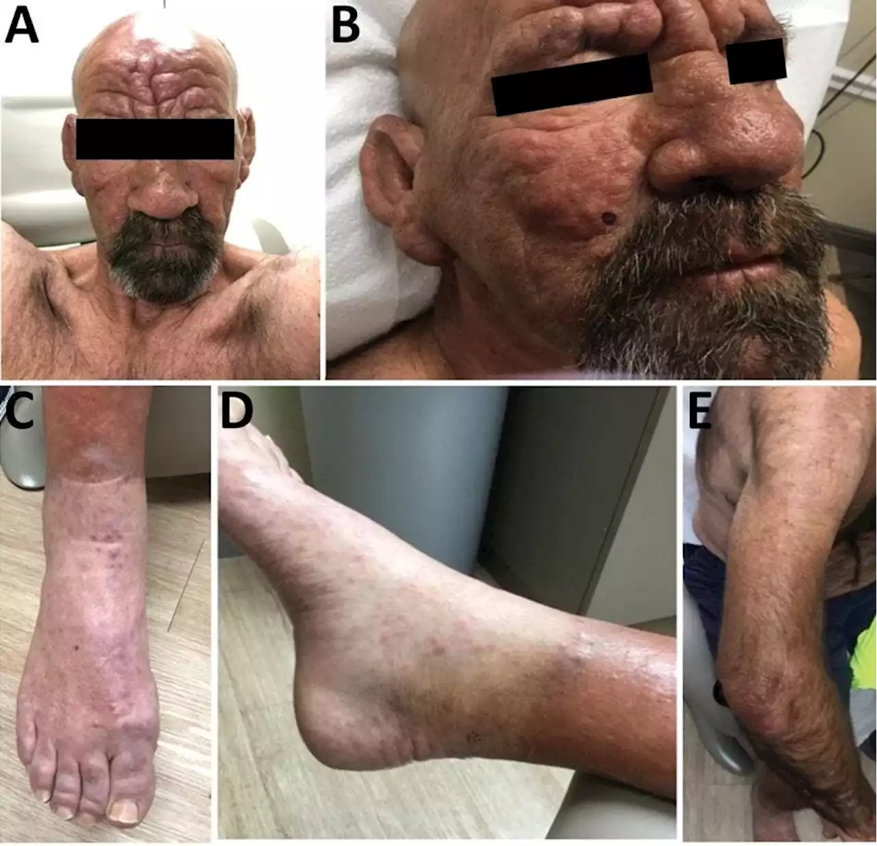 Leprosy May Be An Endemic In Southeastern States: Causes, Symptoms And Treatment