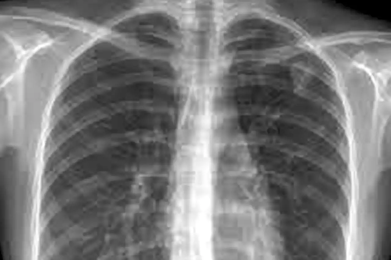 Canadian doctors want better treatments for tuberculosis