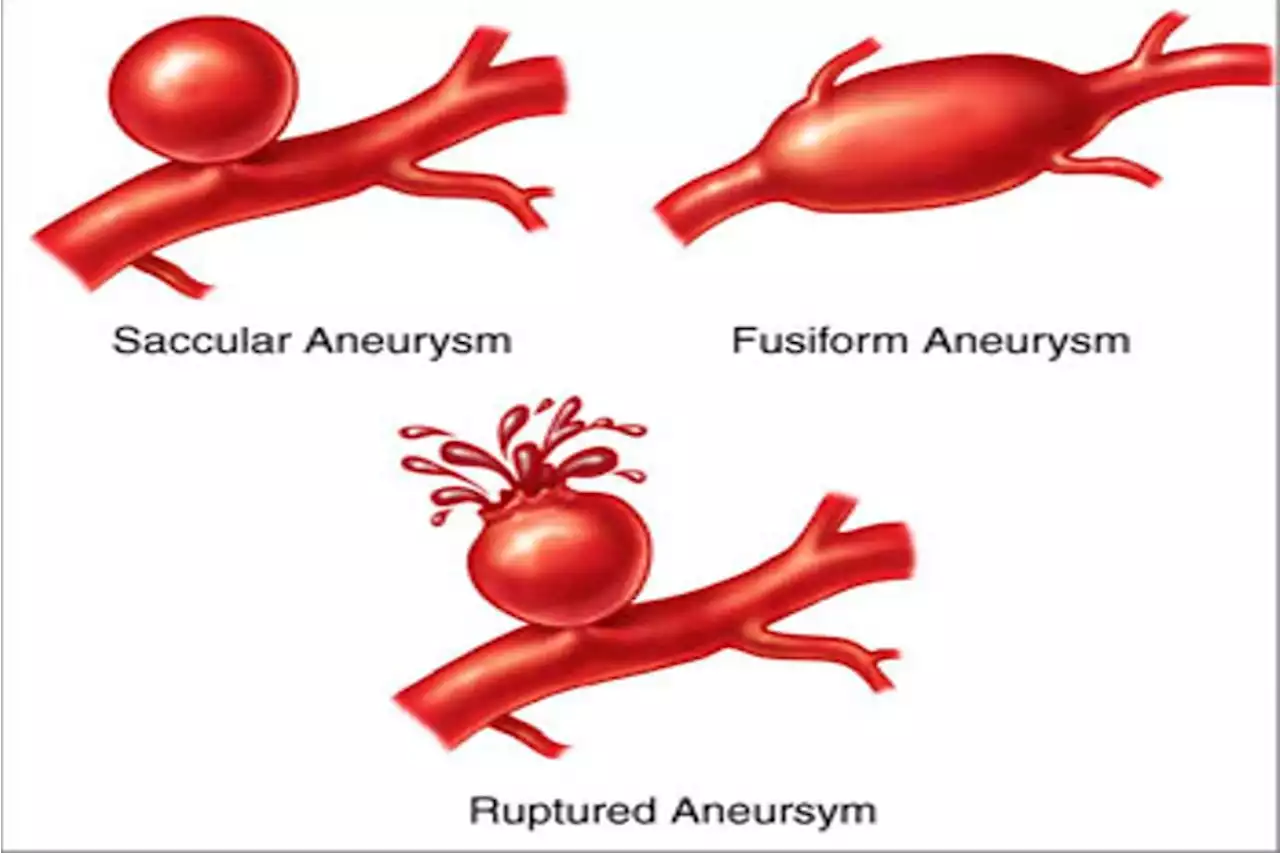Bisa Mematikan, Kenali Aneurisma, Tonjolan di dalam Arteri
