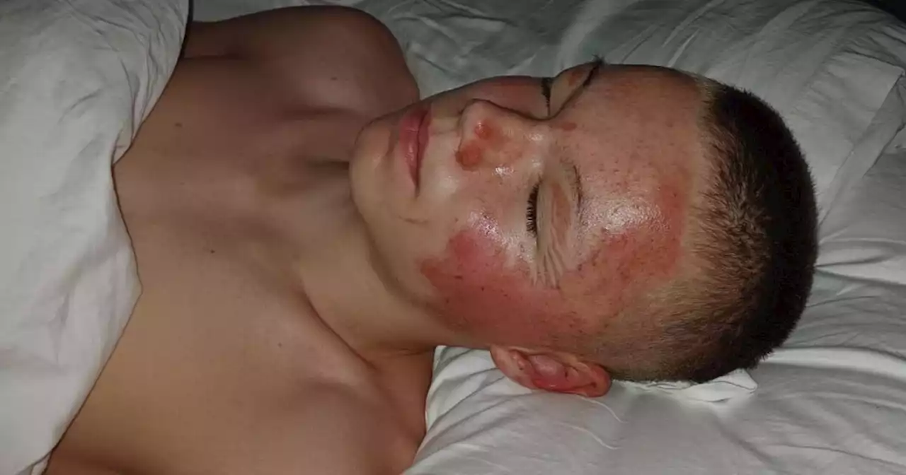 Glasgow schoolboy severely burned on face when aerosol can 'explodes' in fire